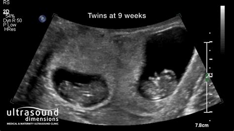 9 weeks pregnant dating scan
